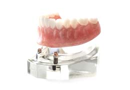 Model of an implant-supported denture